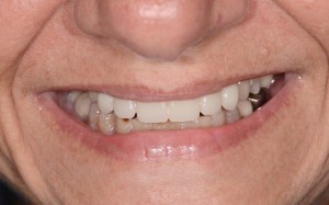 dental implant case study