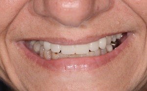 dental implant case study