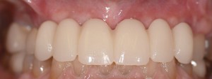 dental implant case study