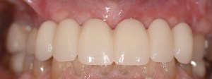 dental implant case study