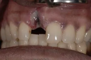 dental implant case study