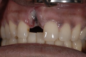 dental implant case study