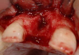 dental implant case study