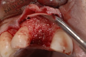 dental implant case study