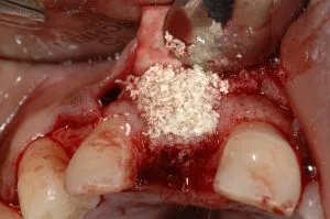 dental implant case study
