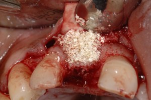 dental implant case study