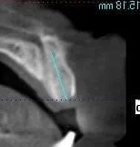 dental implant case study
