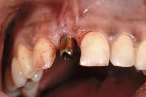 dental implant case study