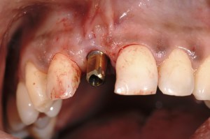 dental implant case study