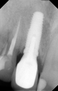 xray of a dental implant