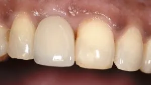 after dental implants