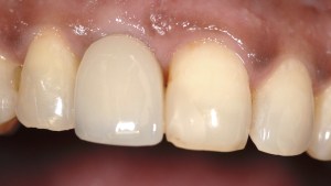 after dental implants