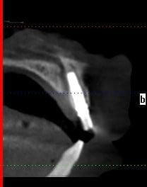 xray of a dental implant
