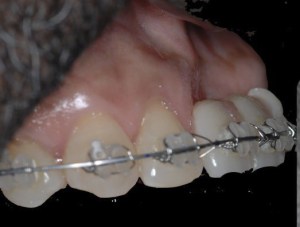 dental implant case study