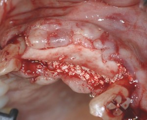 dental implant case study