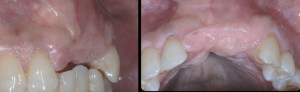 dental implant case study