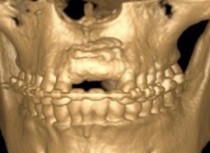 dental implant case study