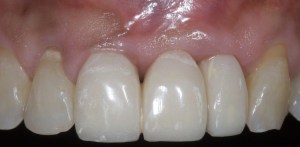 dental implant case study