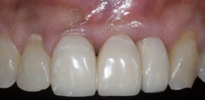 dental implant case study