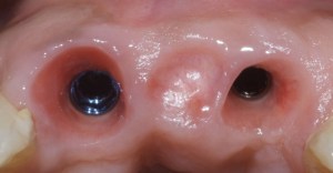 dental implant case study