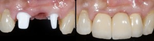 dental implant case study