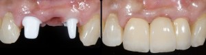 dental implant case study
