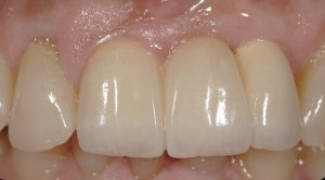dental implant case study