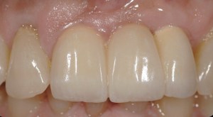 dental implant case study