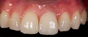 After dental implants